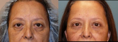 Full Canthopexy with a 4 lid blepharoplasty - 
	Lifting the lateral canthus can be done many ways. This time we created a sling of lower eyelid ligament and attached it right to the orbital bone. This sort of repair is pretty major, but not doing it will lead to droopiness down the road. This way, she will have a great result that lasts.
