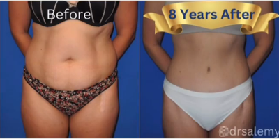 Woman treated with Tummy Tuck - Woman treated with Tummy Tuck