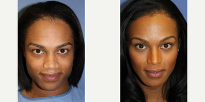 Woman treated with Jaw Reduction - Woman treated with Jaw Reduction
