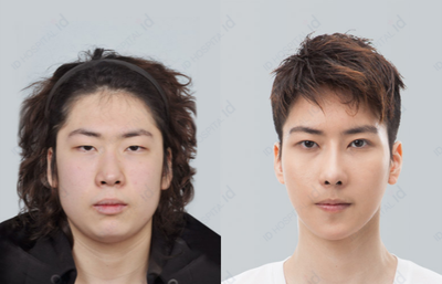 25-34 year old man treated with V Line Surgery - Mouth Protrusion Three Jaw Surgery + High L Cheekbone Reduction + Customized Barbie Line Rhinoplasty + Bambi Eyelid Surgery in ID hospital