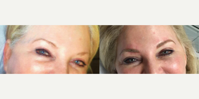 55-64 year old woman treated with Permanent Makeup - The latest technique of permanent makeup application, microblading, that creates the look of actual hair.
