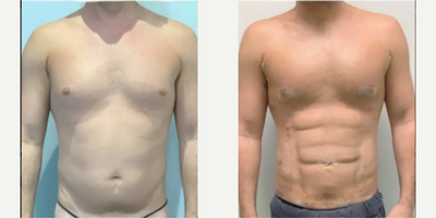 35-44 year old man treated with Pec Implants - 36 ear old man treated with Pec Implants/Gender: Male/Weight: 156 pounds/Height: 55/BMI: 26/Areas Treated: Upper Abdomen, Lower Abdomen, and WaistTime After Surgery: Intraop, 2 years 4 months