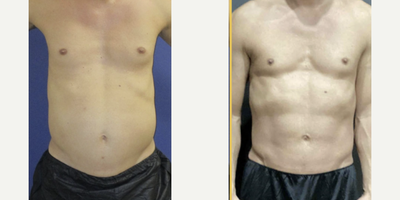 35-44 year old man treated with Pec Implants - 40 year old man treated with Pec Implants/Gender: Male/Height: 6/Weight: 187 poundsBMI: 25/Time After Surgery: pec impants (1 month postop)