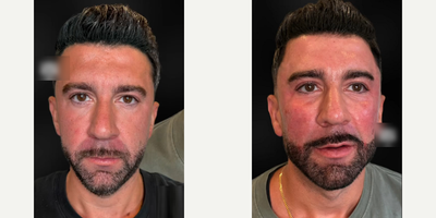Man treated with Facial - Man treated with Facial
