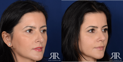 Rhinoplasty - Rhinoplasty
