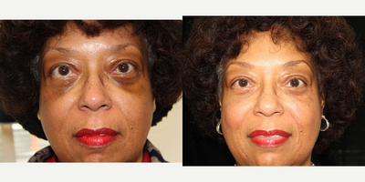 55-64 year old woman treated with Collagen Injection - Platelet rich plasma injections to rejuvenate the tear troughs and help with pigment after surgery.