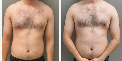 25-34 year old man treated with Gynecomastia Surgery - 27 yo s/p male breast reduction (gynecomastia) performed in our on site AAAA certified operating suite under local anesthesia with sedation