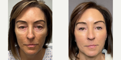 45-54 year old woman treated with Eyelid Surgery, Double Eyelid Surgery - Bilateral upper and lower blepharoplasty.