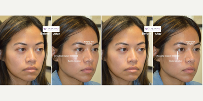 18-24 year old woman treated with Canthoplasty, Eyelid Retraction Repair, Eyelid Surgery, Facial Reconstructive Surgery - Young woman, with genetic Sanpaku eyes with bulging eyes and maxillary hypoplasia (flat midface) and lower eyelid retraction, underwent cosmetic orbital decompression (to treat bulgy eyes), infraorbital rim implant (to treat flat midface) and lower eyelid retraction surgery (to elevated lower eyelids and eliminate sclera show).