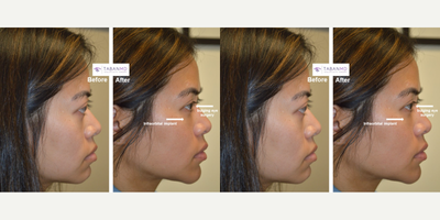 18-24 year old woman treated with Canthoplasty, Eyelid Retraction Repair, Eyelid Surgery, Facial Reconstructive Surgery - Young woman, with genetic Sanpaku eyes with bulging eyes and maxillary hypoplasia (flat midface) and lower eyelid retraction, underwent cosmetic orbital decompression (to treat bulgy eyes), infraorbital rim implant (to treat flat midface) and lower eyelid retraction surgery (to elevated lower eyelids and eliminate sclera show).