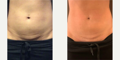 25-34 year old woman treated with CoolSculpting, Microneedling RF, Emsculpt, Laser Resurfacing - A combination of Coolsculpting, RF Microneedling and Fraxel topped off with 4 Emsculpt treatments to treat post baby pooch and c-section scarring.