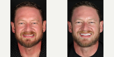 Man treated with Dental Implants - Full mouth veneers, crowns, posterior dental implants to replace .