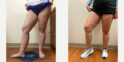 35-44 year old woman treated with EVLT, Sclerotherapy - Patient had an EVLT and 2 sclerotherapy treatments performed.