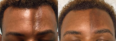 ALMI (Autologous Lipocyte Micronized Injection) for correction of Craniofacial Abnormality - This patient presented with an indentation on his forehead from a craniofacial abnormality present since birth. ALMI (Autologous Lipocyte Micronized Injection) was used to fill in the indentation, dramatically improving his appearance. ALMI is a technology that uses your own fat and stem cells to rejuvenate and revive different areas of the face, hands, body, as well as for hair restoration.