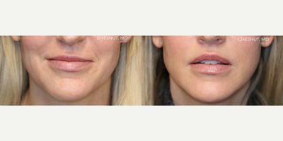 LoveLift, Deep Plane Lip Lift - LoveLift, Deep Plane Lip Lift with Corner Lift and Filler Dissolution.