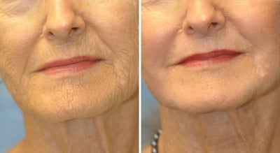 67 Year Old Female Treated for Unacceptable Cosmetic Appearance of Face - 
	Prodecure: CO2 Laser Treatement
