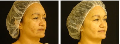 Chemical Peels - 49 year old female. 2011 Peel Challenge patient. Series of 3 Chemical Peels (Vitalize, Rejuvenize, and Illuminize) plus home care products  SkinMedica: TNS Essential Serum, TNS Eye Repair, Retinol Complex, Environmental Defense Sunscreen