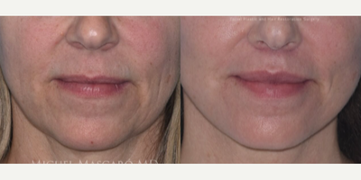 Woman treated with SMAS Facelift - Woman treated with Deep Plane Facelift, SMAS Facelift, and Lip Lift. Patient is shown before and 1 year post-op.