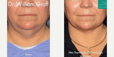 Woman treated with ThermiTight - ThermiTight with MicroLipo to contour the neck and chin by Dr. Groff