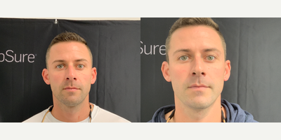 Man treated with TempSure Envi - Before and after of male with only 1 treatment of Tempsure (RF)