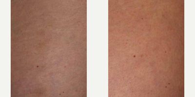 Woman treated with ResurFX - Photo provided courtesy of Lumenis, Ltd., performed by Matteo Tretti Clementoni, MD