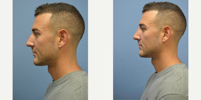 Man treated with Juvederm, Nonsurgical Nose Job, Restylane - Man treated with Juvederm, Nonsurgical Nose Job, Restylane