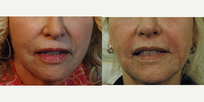 Remove Smoker's Lines, Fractional Laser Resurfacing Los Angeles - 71 year old patient before and after ONE Profractional laser resurfacing procedure for deep smoker's lines around the mouth.  A better alternative to Fraxel Laser Resurfacing when you want better results with deeper resurfacing.