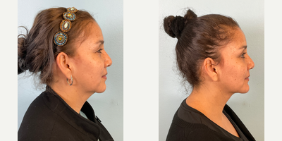35-44 year old woman treated with Buccal Fat Removal, Chin Implant, Facial Fat Transfer - Buccal Fat Removal, Jawline Sculpting, Fat Transfer and Chin Implant