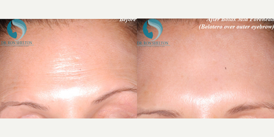 35-44 year old woman treated with Fraxel Repair - Botox mid forehead. Filler in crease above outer eyebrows, too close to eye to inject with Botox