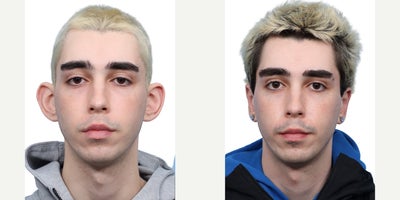 Man treated with Ear Surgery - Man treated with Ear Surgery