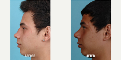 18-24 year old man treated with Revision Rhinoplasty - This patient presented after a devastating injury where he lost most of the cartilage in his septum. He complained of severe breathing difficulties through both his nostrils with the inability to breathe from either side of his nose. He also was very concerned from the collapsed appearance of his nose. He was found to have lost most of his cartilage from his septum from a complication stemming from his injury. A small strip of cartilage from his rib was used to reconstruct his nose and correct his breathing problem.