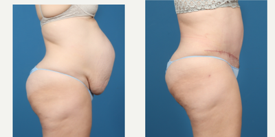 35-44 year old woman treated with Tummy Tuck, Mommy Makeover - Patient had a severe rectus diastasis and excess skin; after photos show her 2 months post abdominoplasty, scar is fresh and will continue to fade and heal