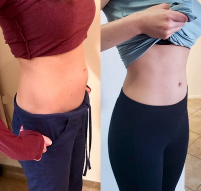 Patient treated with Emsculpt - Emsculpt can do it for you - we see a lot of results like that for those who finally want to see a definition on their abs - icing on a cake!