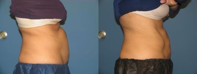 Coolsculpting - Patient had coolsculpting to treat her upper and lower abdomen for fat reduction.  This is one treatment just 8 weeks post!