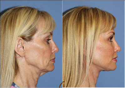 Lower Face and Neck Lift without General Anesthesia  - When this 60 year old patient came to Dr. Kevin Sadati for a cosmetic consultation her chief complaint with extra skin around her lower face and neck area. As a board certified facial plastic and reconstructive surgeon, Dr. Kevin Sadati performed a lower face and neck lift without the need for general anesthesia. The patient's facelift surgery was comfortably performed in office with local anesthesia and twilight sedation.