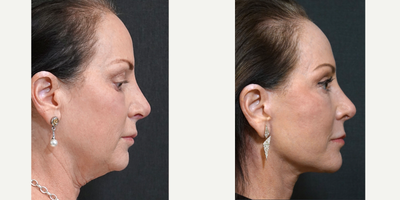 65-74 year old woman treated with Facelift, Facial Fat Transfer, Dermabrasion, Eyelid Surgery - This patient underwent a 3-D (Y-SMAS) facelift, facial fat transfer, lower blepharoplasty, CO2 lasabrasion and perioral medical diamond dermabrasionA 3-D (Y-SMAS) facelift is a more complete dissection employing 3 vectors. I consider it like a deep plane facelift but more sculptural and in my experience, it lasts longer and it is more effective for the nasolabial folds.