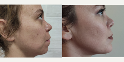 35-44 year old woman treated with Chin Implant - Medpor Chin implantation via submental incision