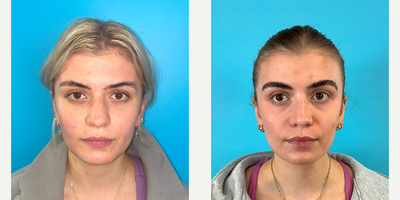 18-24 year old woman treated with Rhinoplasty, Revision Rhinoplasty, Septoplasty - I'm happy to share this young woman's 2 year results following a Revision Rhinoplasty and Septoplasty.  The nose is narrowed overall but a natural, non-pinched, result is maintained.  A subtle dorsal hump reduction and tip refinement were also performed.People always ask about the recovery time following a Rhinoplasty.  It takes time for the swelling to come down and so I always try to share the immediate postop photos from the operating room (OR) with my patients to allow them to get an idea of their final results and have something to look forward to while the swelling improves over time.  The OR photos are in the last pic and you can see how similar they are to the long term results... 75% of the swelling comes down after a month while the rest takes a year to a year and half.  To accelerate the swelling resolution,  I see patients in the office every 2-3 months for steroid injections to the nose, especially the tip, to further help with recovery time...Full views of this patient's final results are shown.  Also notice how the tip stays in the good position even when smiling.Please look at the scar from the worm's eye view (taken from below the patient).  I always try to create a surgical scar that is almost invisible.The overall goal is to always maintain a natural result... The standard key maneuvers included a component hump reduction, reverse angulated caudal septal trim, and tip deprojection.  Multiple grafts were used including a columellar strut graft, spreader grafts, alar contour grafts, and a mastoid fascia tip graft.  All this was done to help provide long-term stability and structure to maintain the aesthetic and functional goals...