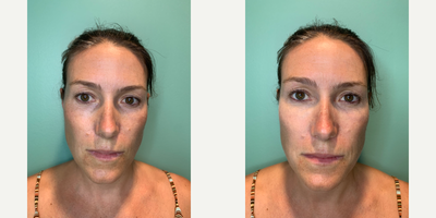 35-44 year old woman treated with Ultherapy and Tear Trough Fillers - Under eyes treated with Ultherapy and tear trough fillers to rejuvenate, refresh and tighten the periocular area.