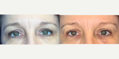 45-54 year old woman treated with Xeomin - 45-54 year old woman treated with Xeomin to crows feet and glabellar, shown 2 weeks post op.