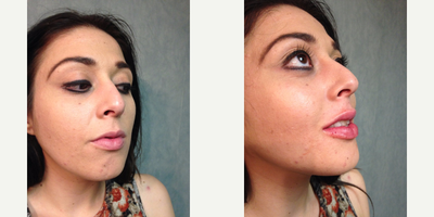 18-24 year old woman treated with Lip Augmentation - injection, technique, experience would give the result