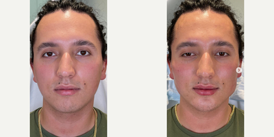 Man treated with Facial - Man treated with Facial