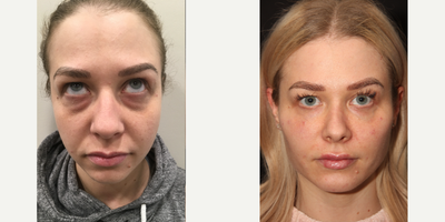 25-34 year old woman treated with Teosyal - 32 year old female patient was treated with 10 syringes of dermal filler to replace lost volume and for facial contouring, 1 year following rhinoplasty and chin augmentation with Dr Philip Solomon.