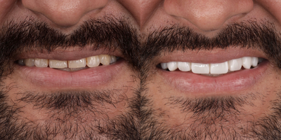 25-34 year old man treated with Porcelain Veneers, Lumineers, Smile Makeover, SmileDirectClub, Tooth Repair, BriteSmile - We improved the color and shape of the teeth with porcelain veneers.