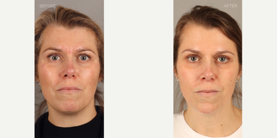 Filler Chin Augmentation Post-Rhinoplasty - 43-year-old female previously had a rhinoplasty and requested chin augmentation to provide balance with her nose. She is shown two weeks after non-surgical chin filler placement.