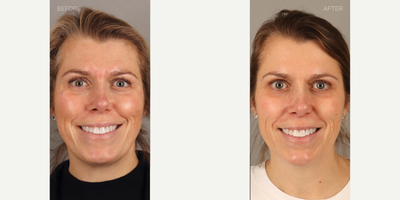 Filler Chin Augmentation Post-Rhinoplasty - 43-year-old female previously had a rhinoplasty and requested chin augmentation to provide balance with her nose. She is shown two weeks after non-surgical chin filler placement.