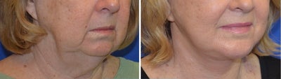 55-64 year old woman treated with Chin Implant - Chin Implant