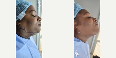 45-54 year old woman treated with Aqualyx, Botox, Kybella - i did double chin removal and marking jawline.
