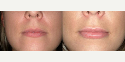25-34 year old woman treated with Lip Implants - Perma Facial Implant by Surgisil.