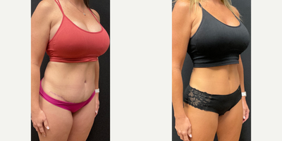 45-54 year old woman treated with Ozempic for Weight Loss - Patient lost 27lbs in 8 months on our Skinny Shot (Semaglutide).